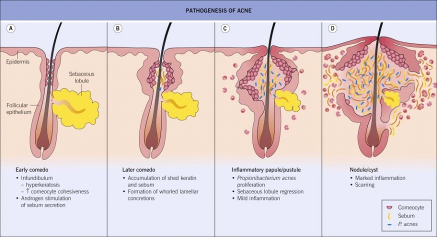 acne-diagram