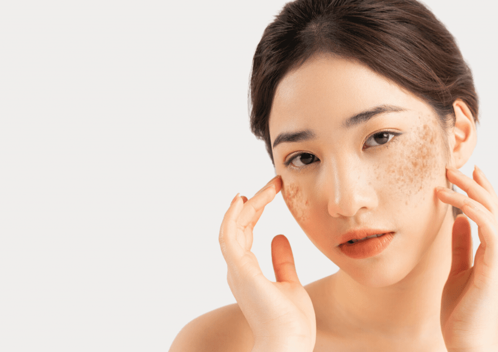 Pigmentation Melasma Malaysia Verve Clinic Petaling Jaya